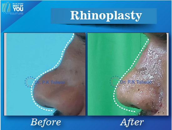 rhinoplasty surgery result